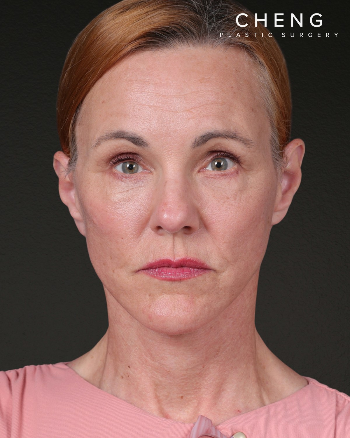 Co2 Laser Before & After Gallery - Patient 110268 - Image 2