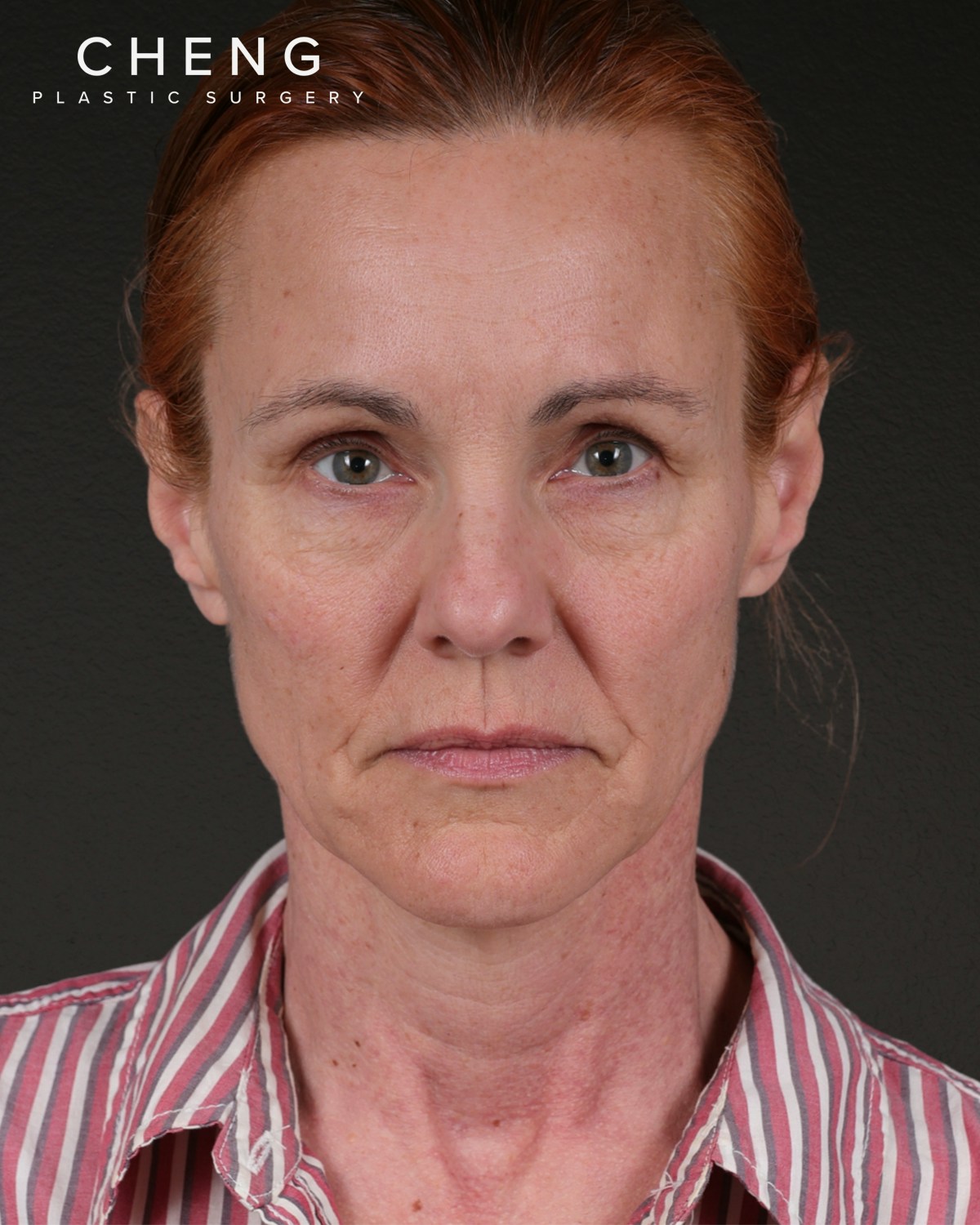 Co2 Laser Before & After Gallery - Patient 110268 - Image 1