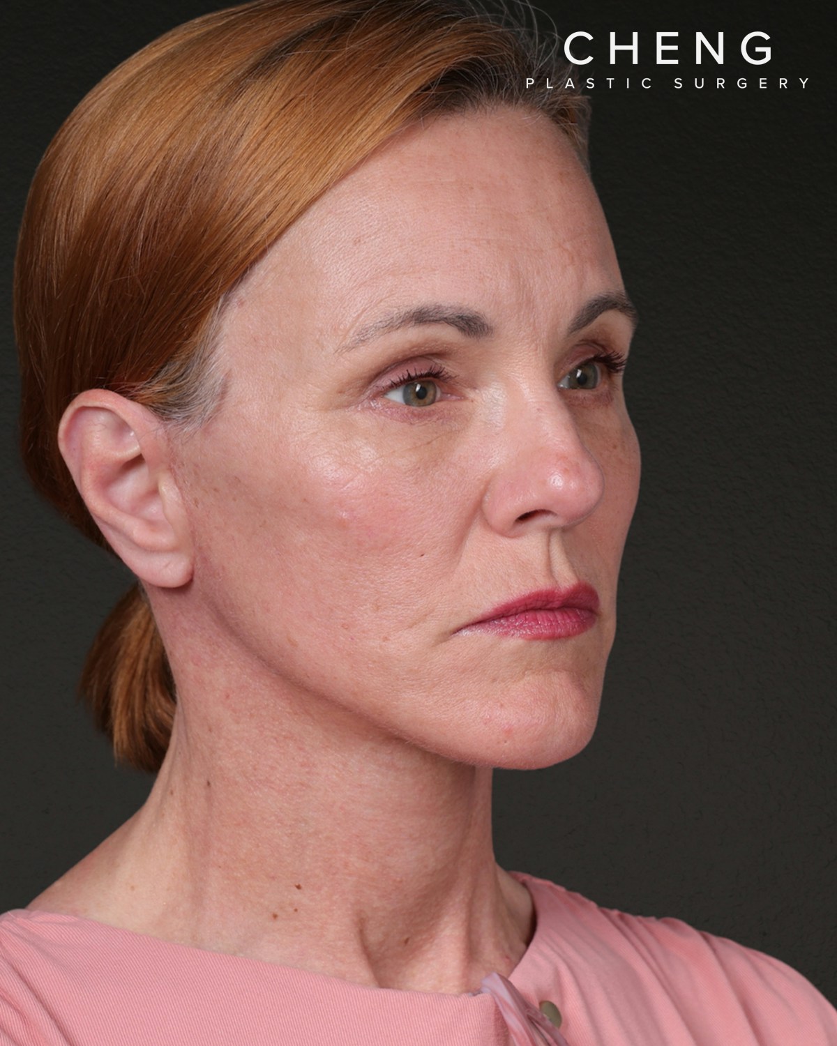Co2 Laser Before & After Gallery - Patient 110268 - Image 4
