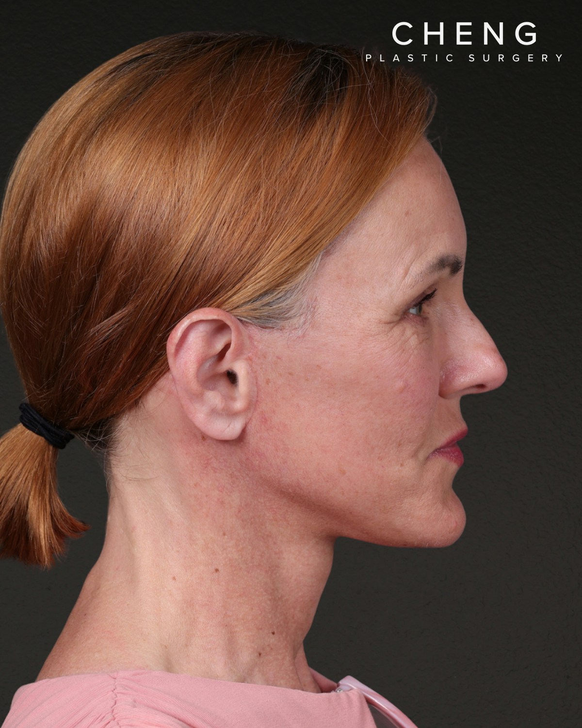 Co2 Laser Before & After Gallery - Patient 110268 - Image 6