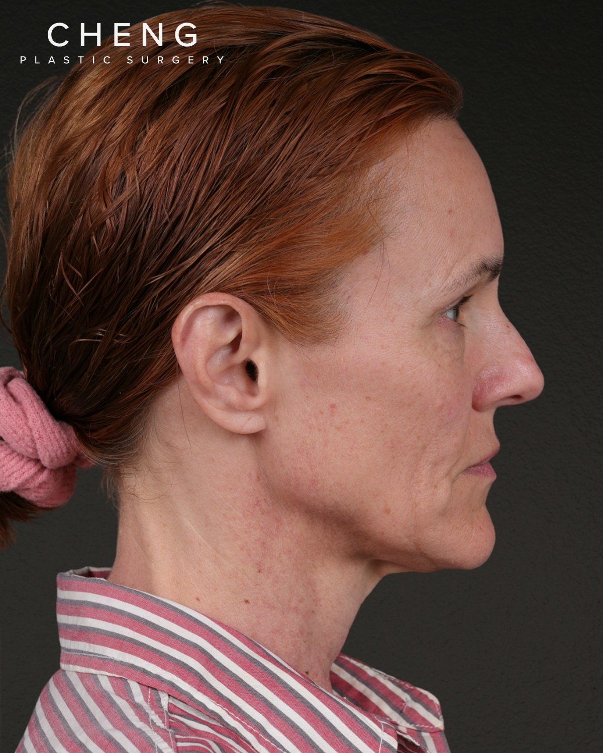 Co2 Laser Before & After Gallery - Patient 110268 - Image 5