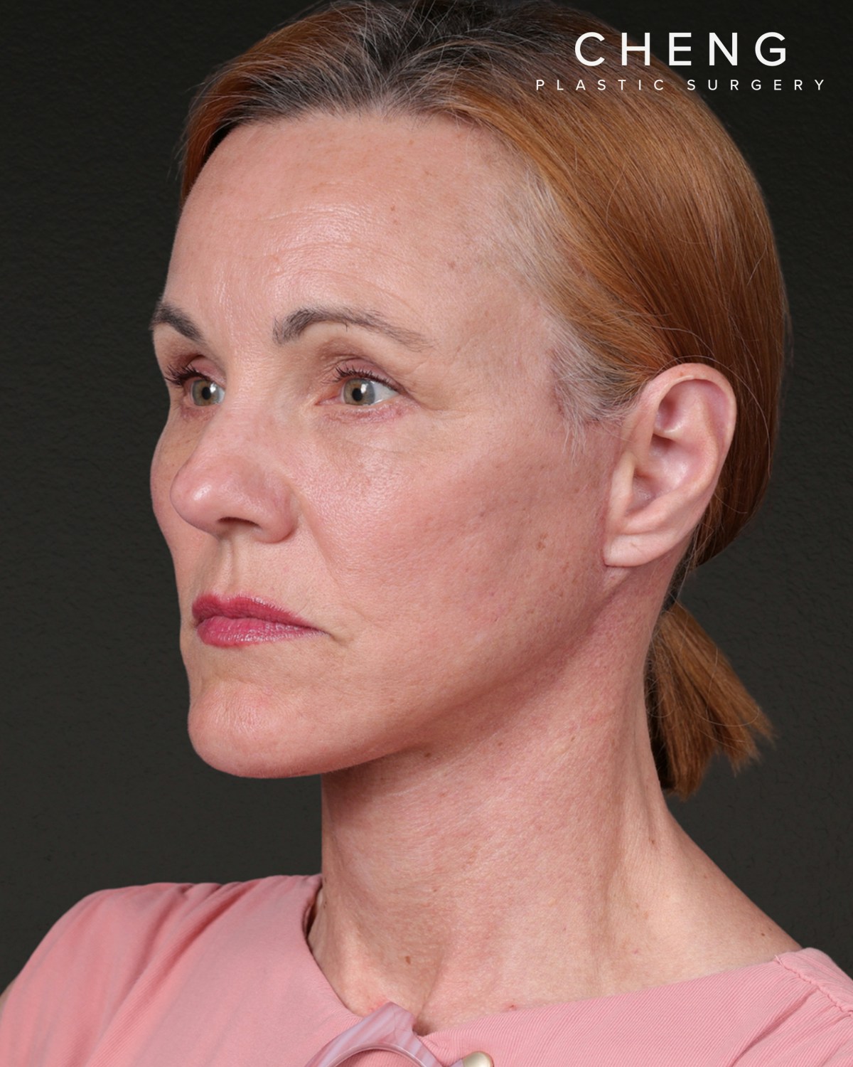 Co2 Laser Before & After Gallery - Patient 110268 - Image 8