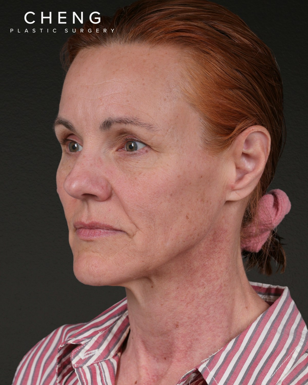 Co2 Laser Before & After Gallery - Patient 110268 - Image 7