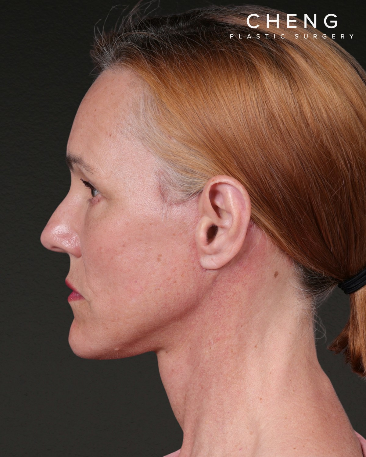 Co2 Laser Before & After Gallery - Patient 110268 - Image 10