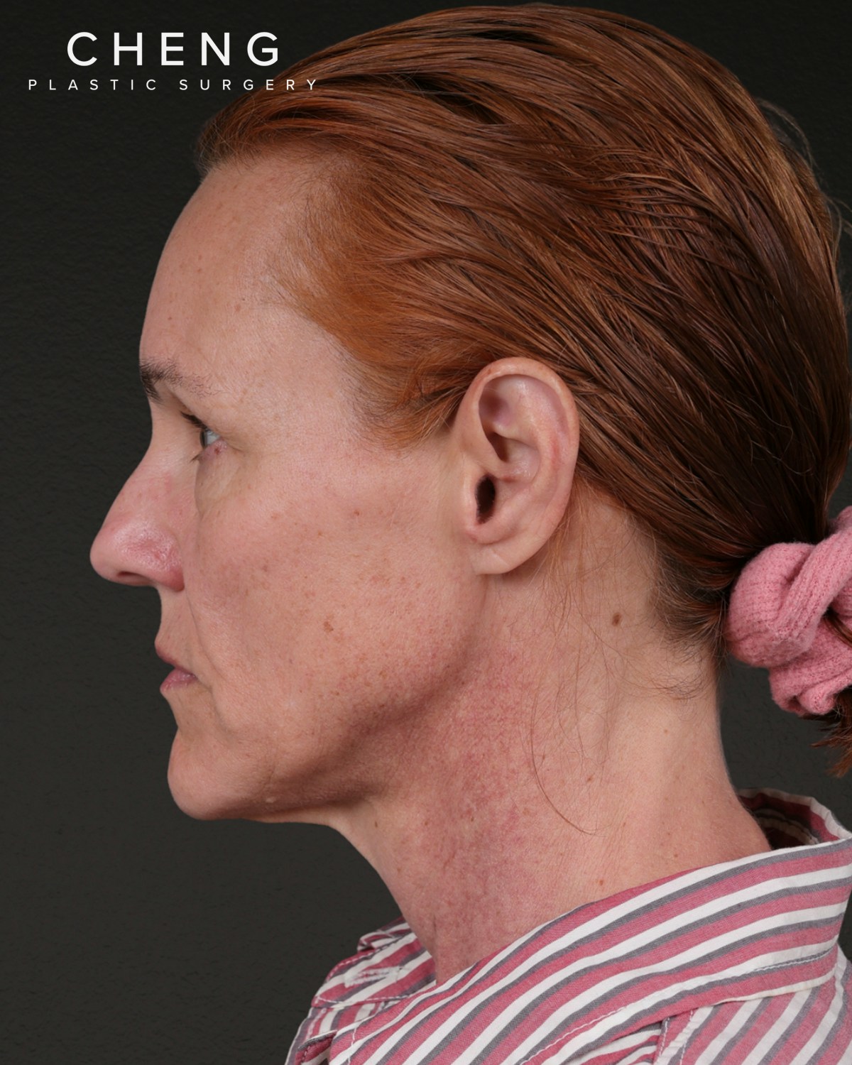 Co2 Laser Before & After Gallery - Patient 110268 - Image 9
