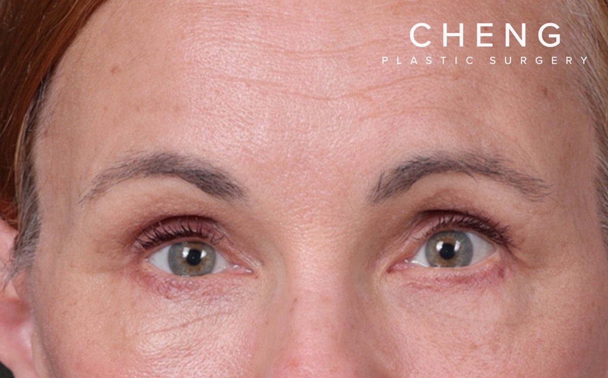 Brow Lift Before & After Gallery - Patient 363898 - Image 2
