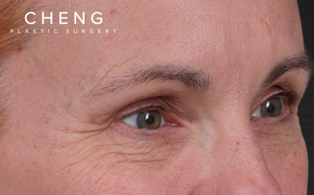 Brow Lift Before & After Gallery - Patient 363898 - Image 3