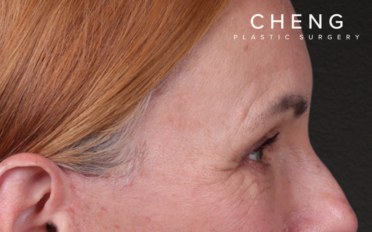 Brow Lift Before & After Gallery - Patient 363898 - Image 6