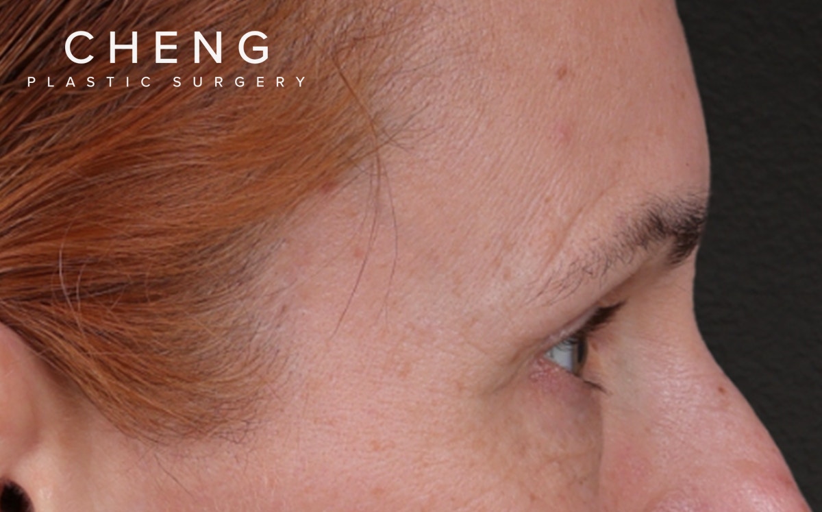 Brow Lift Before & After Gallery - Patient 363898 - Image 5