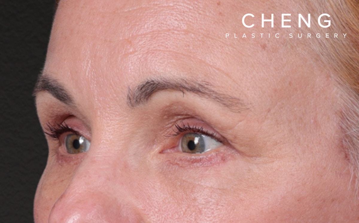 Brow Lift Before & After Gallery - Patient 363898 - Image 8