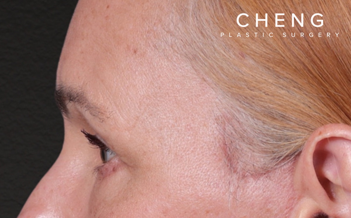 Brow Lift Before & After Gallery - Patient 363898 - Image 10