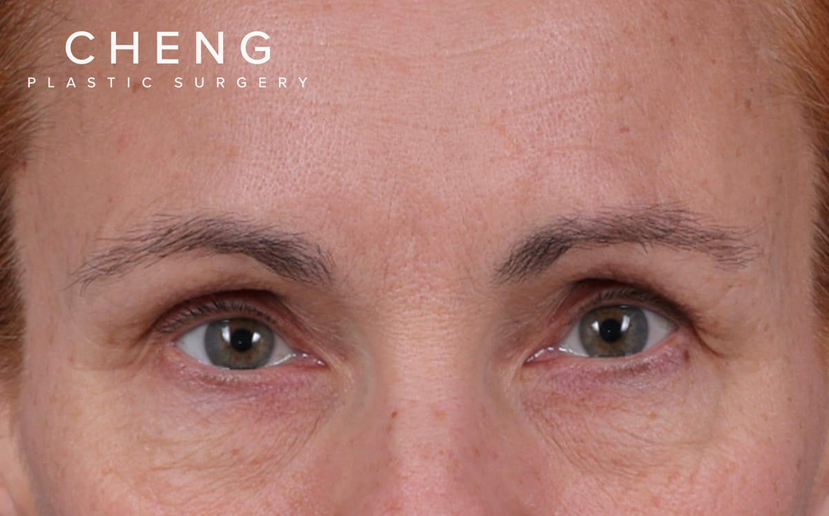 Brow Lift Before & After Gallery - Patient 363898 - Image 1