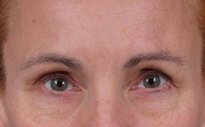Blepharoplasty Before & After Gallery - Patient 117386 - Image 1