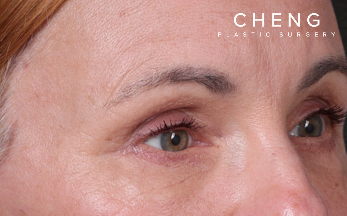 Brow Lift Before & After Gallery - Patient 363898 - Image 4