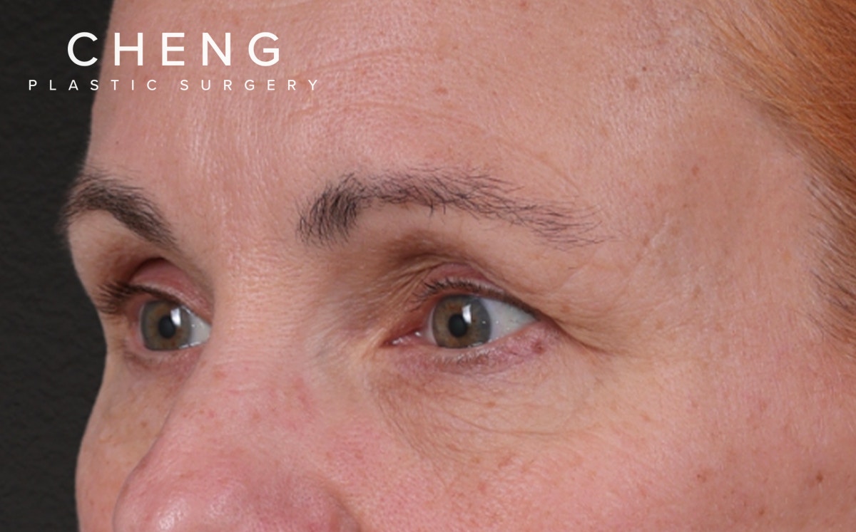 Brow Lift Before & After Gallery - Patient 363898 - Image 7