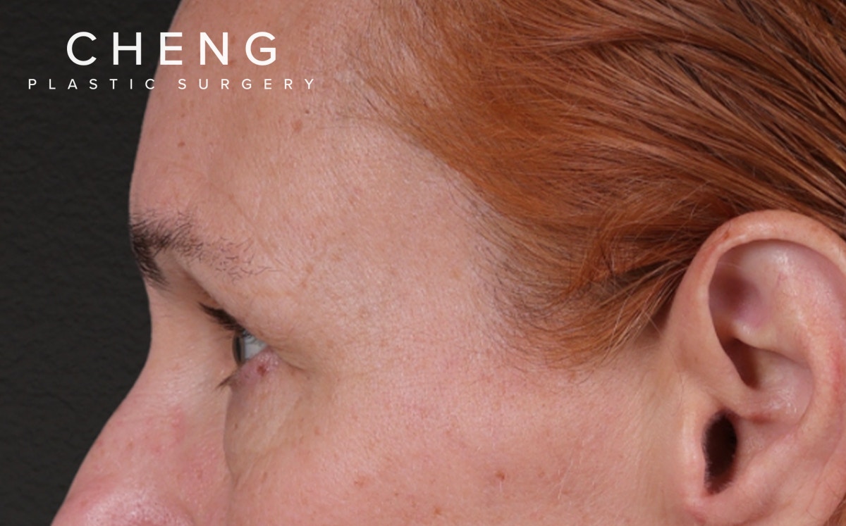 Brow Lift Before & After Gallery - Patient 363898 - Image 9