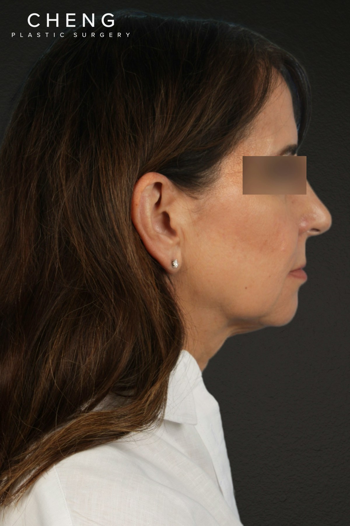 Facelift Before & After Gallery - Patient 407291 - Image 9