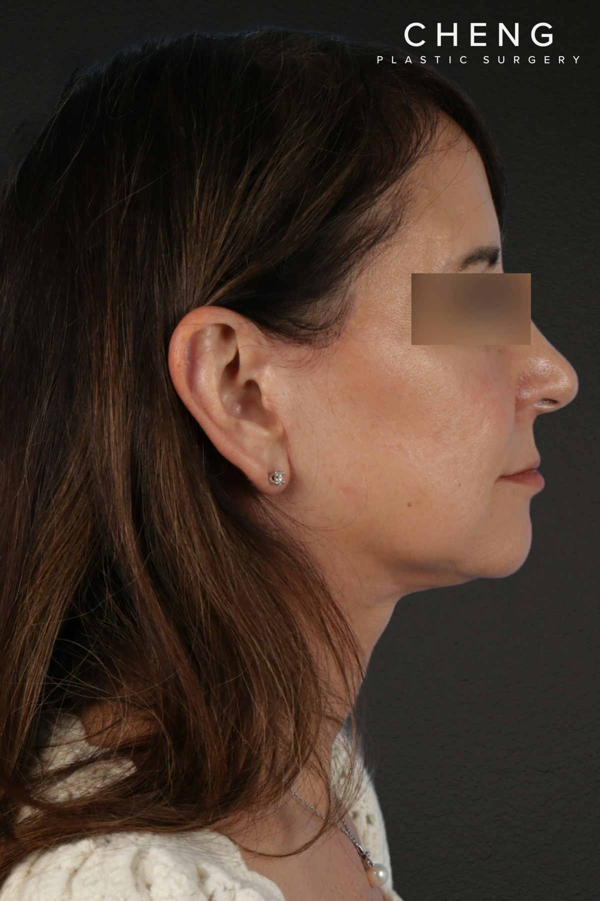 Facelift Before & After Gallery - Patient 407291 - Image 10