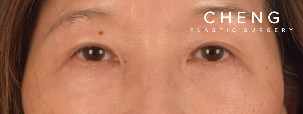 Brow Lift Before & After Gallery - Patient 542005 - Image 2