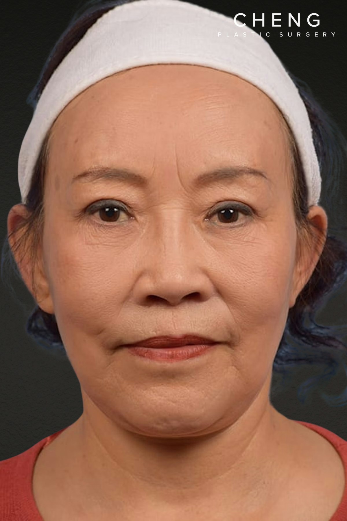 Brow Lift Before & After Gallery - Patient 375961 - Image 2