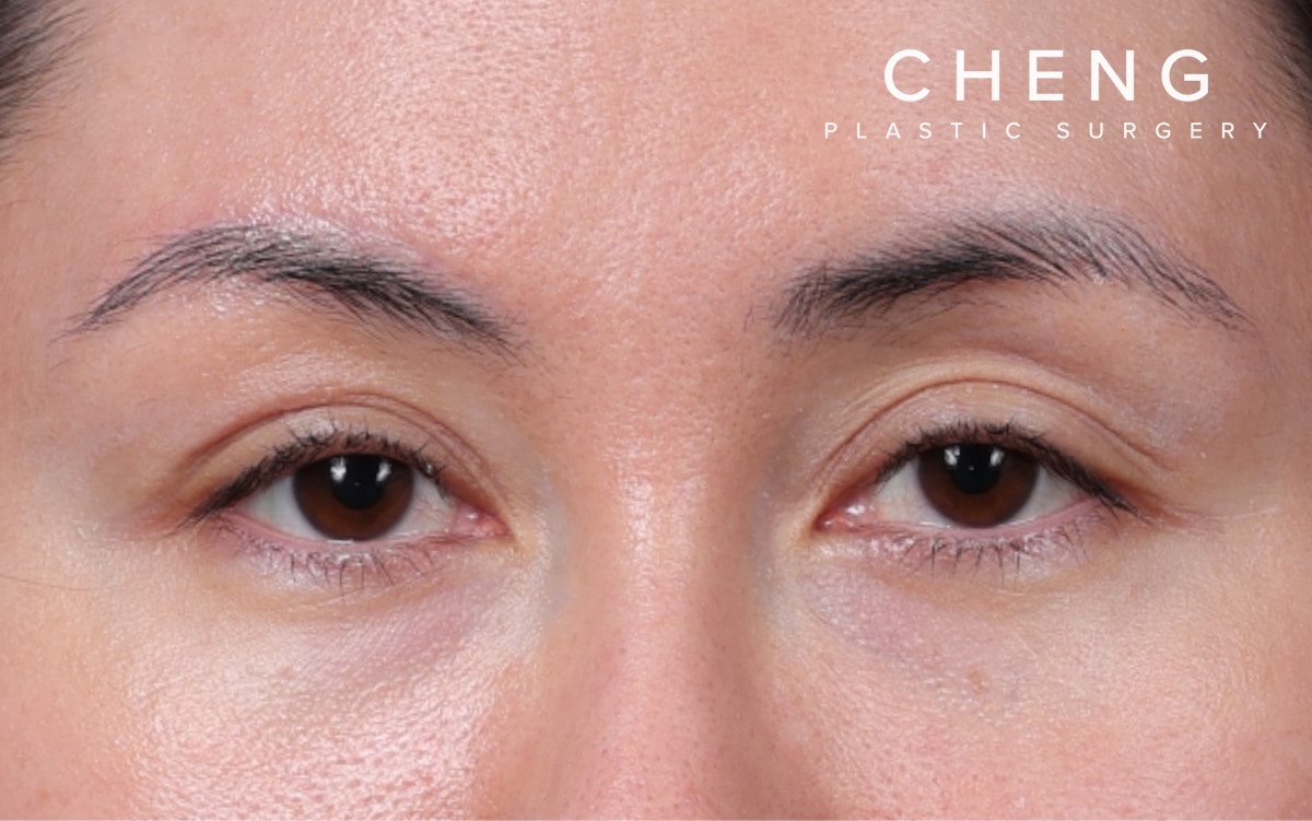 Brow Lift Before & After Gallery - Patient 324298 - Image 2