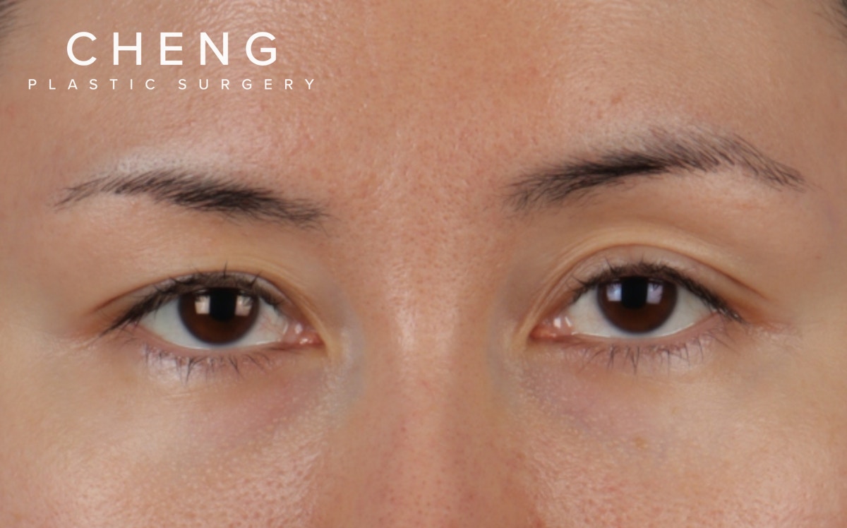 Brow Lift Before & After Gallery - Patient 324298 - Image 1