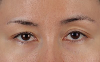 Blepharoplasty Before & After Gallery - Patient 751991 - Image 1