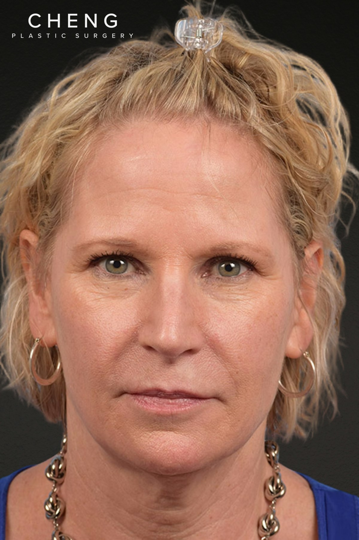 Brow Lift Before & After Gallery - Patient 415432 - Image 1