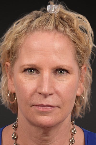 Fat Grafting Before & After Gallery - Patient 313784 - Image 1