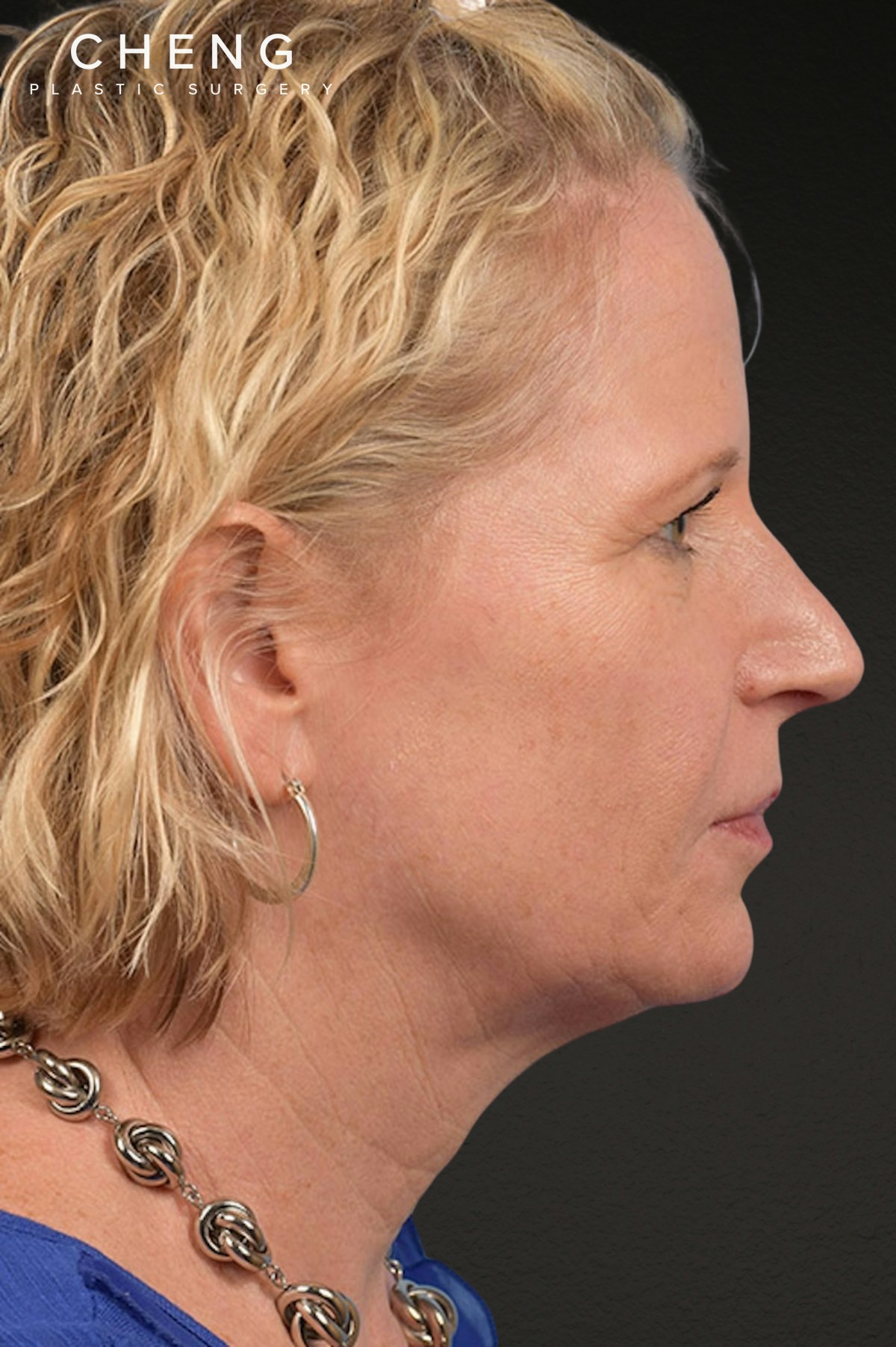 Brow Lift Before & After Gallery - Patient 415432 - Image 5