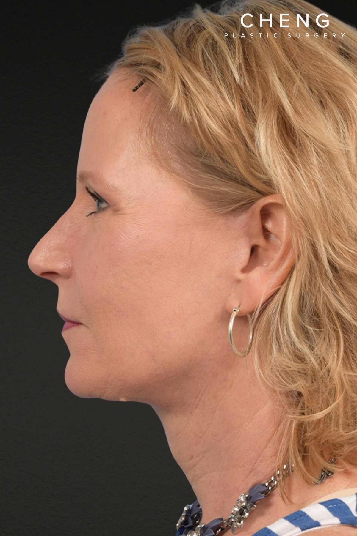 Brow Lift Before & After Gallery - Patient 415432 - Image 10