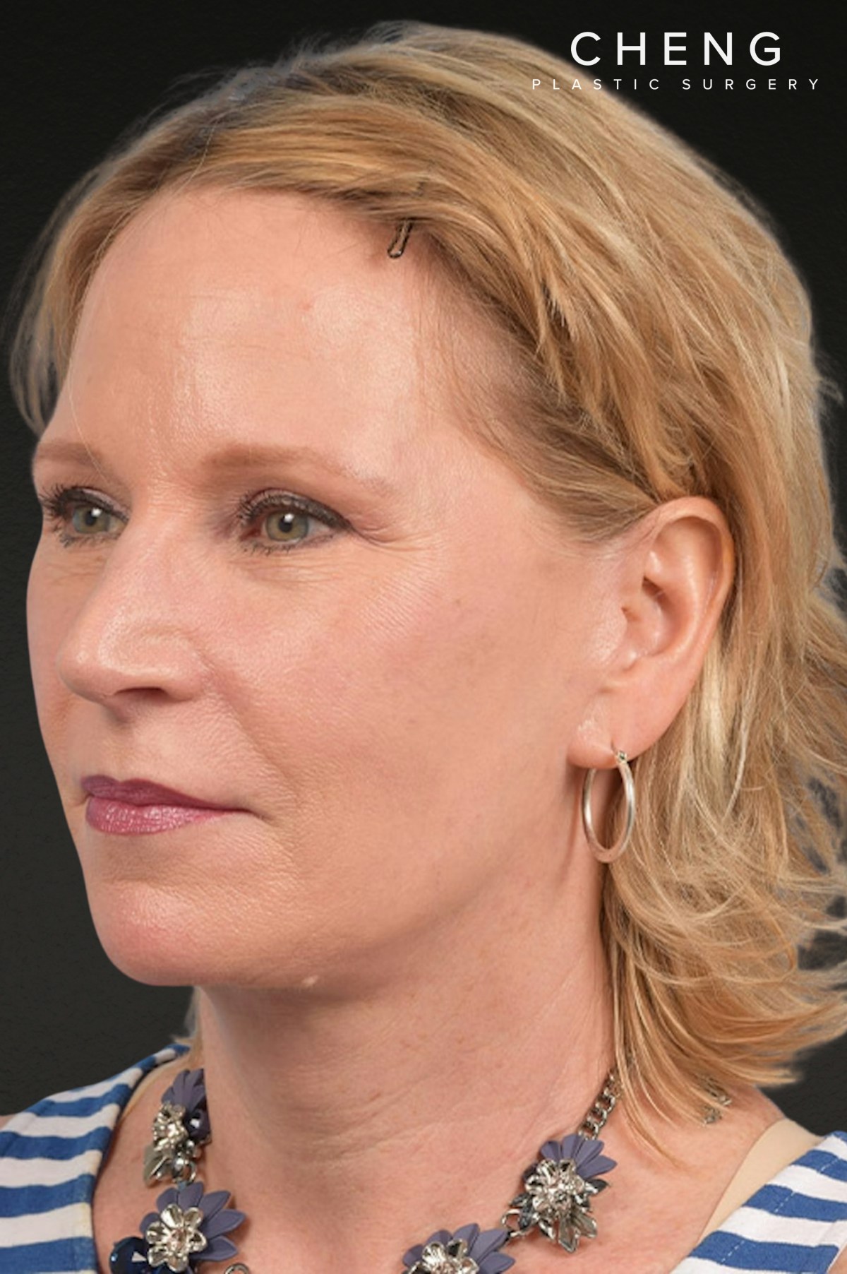 Brow Lift Before & After Gallery - Patient 415432 - Image 8