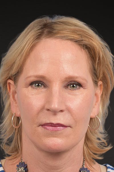 Fat Grafting Before & After Gallery - Patient 313784 - Image 2