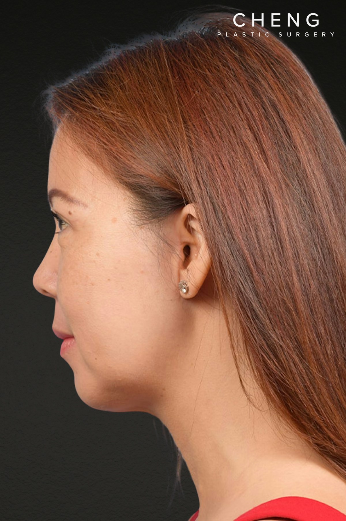 Chin Augmentation Before & After Gallery - Patient 163562 - Image 4