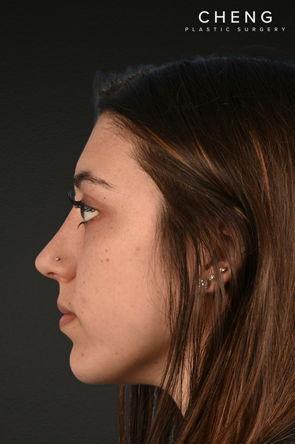 Chin Augmentation Before & After Gallery - Patient 290451 - Image 4