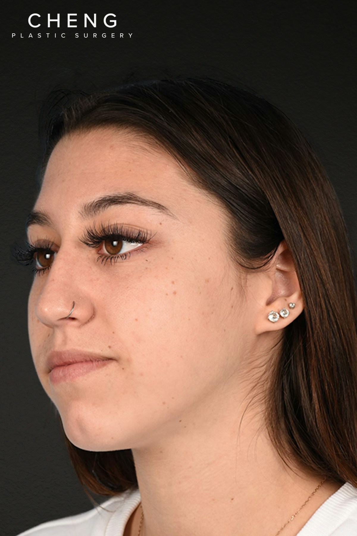 Chin Augmentation Before & After Gallery - Patient 290451 - Image 1