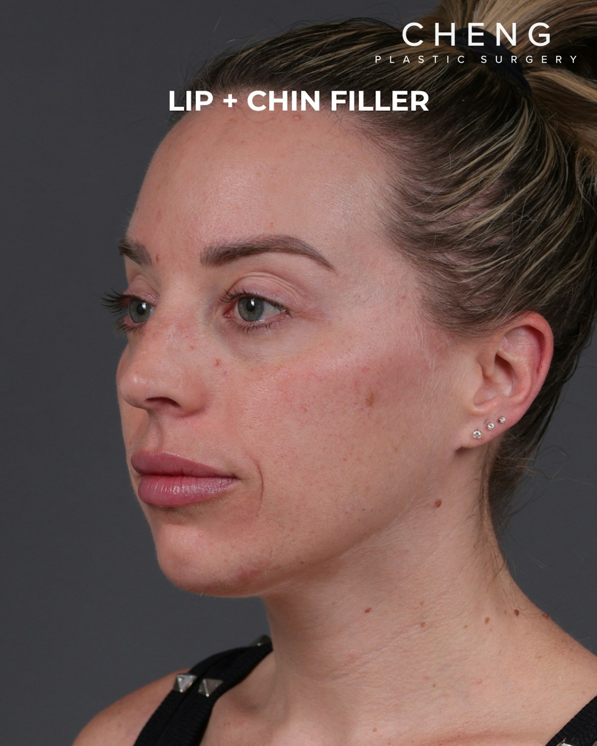 Dermal Fillers Before & After Gallery - Patient 916688 - Image 8