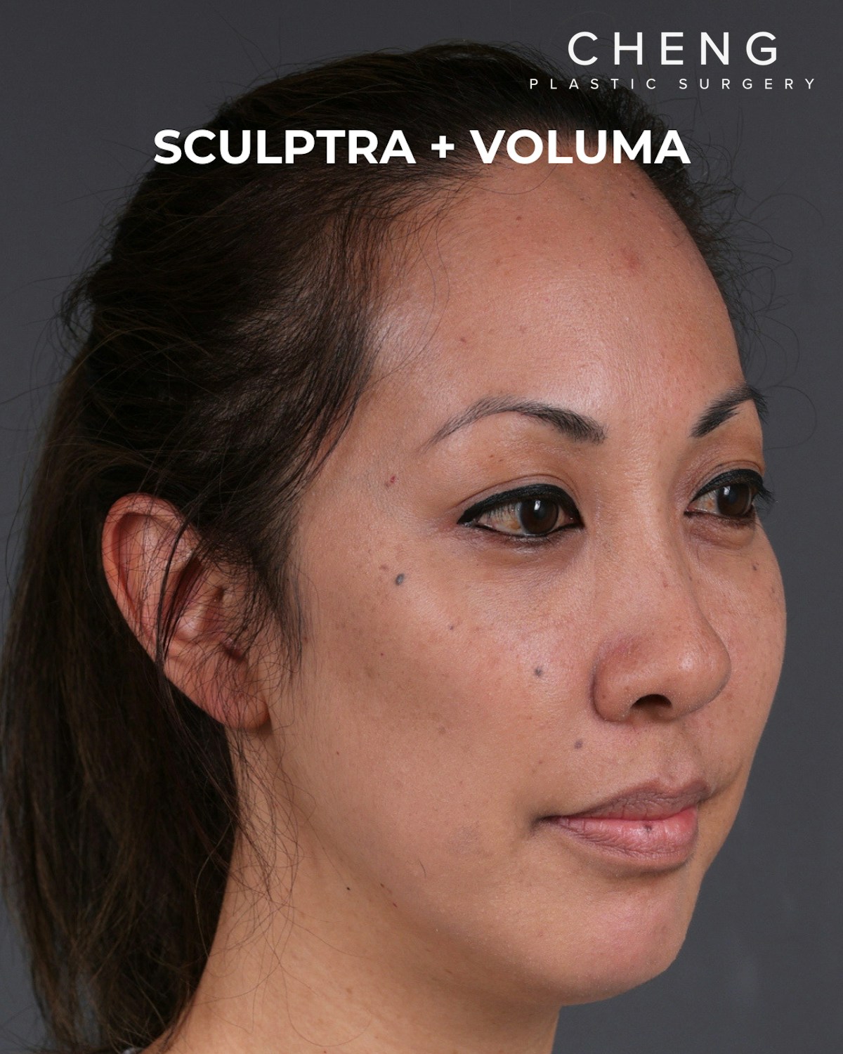Dermal Fillers Before & After Gallery - Patient 172558 - Image 4