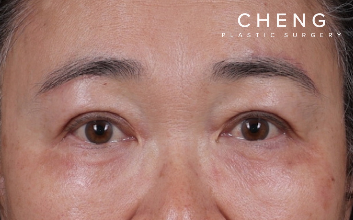 Blepharoplasty Before & After Gallery - Patient 140258 - Image 2