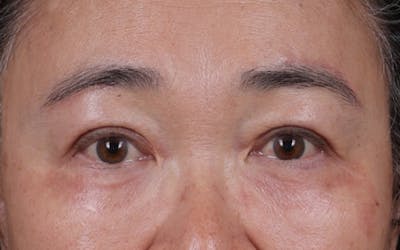 Fat Grafting Before & After Gallery - Patient 198306 - Image 2