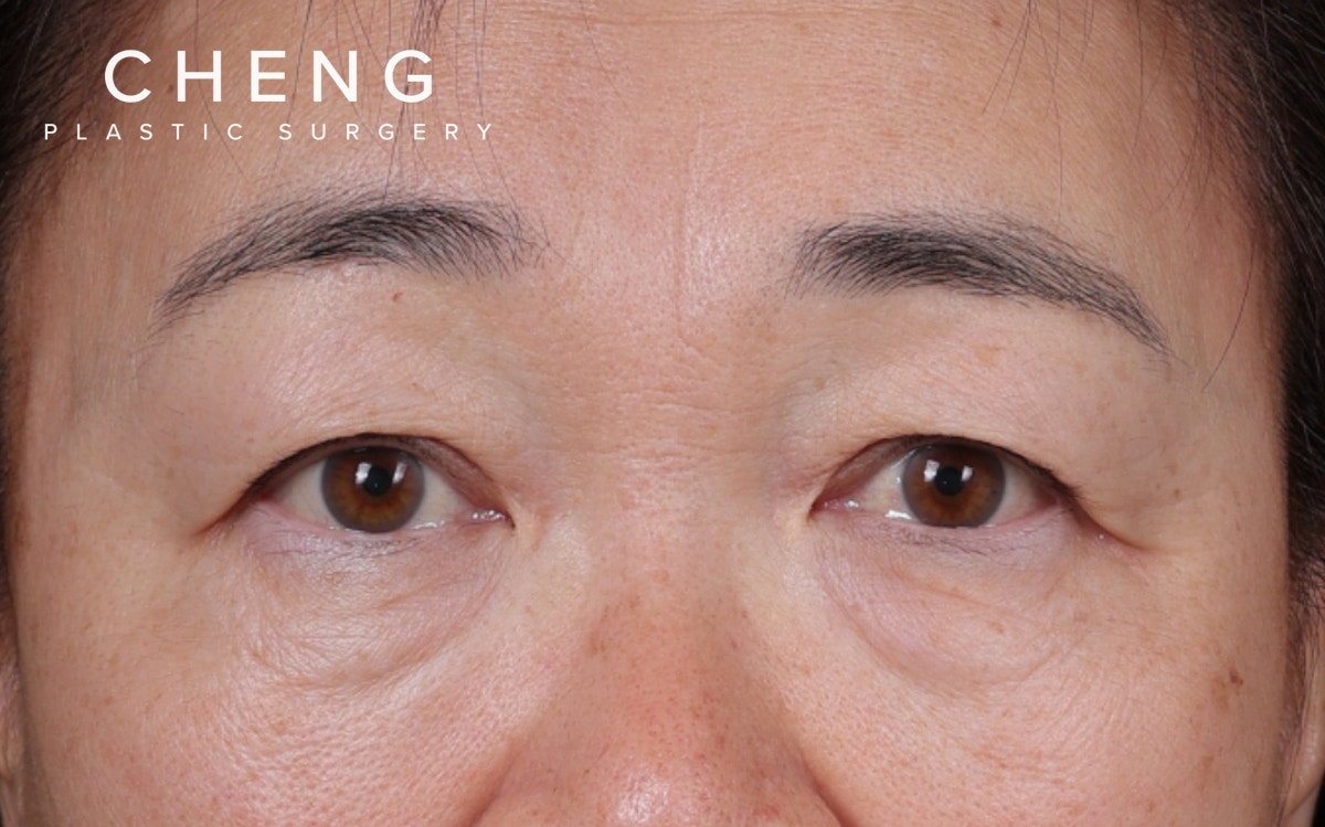 Blepharoplasty Before & After Gallery - Patient 140258 - Image 1