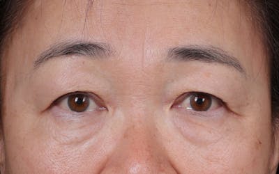 Fat Grafting Before & After Gallery - Patient 198306 - Image 1