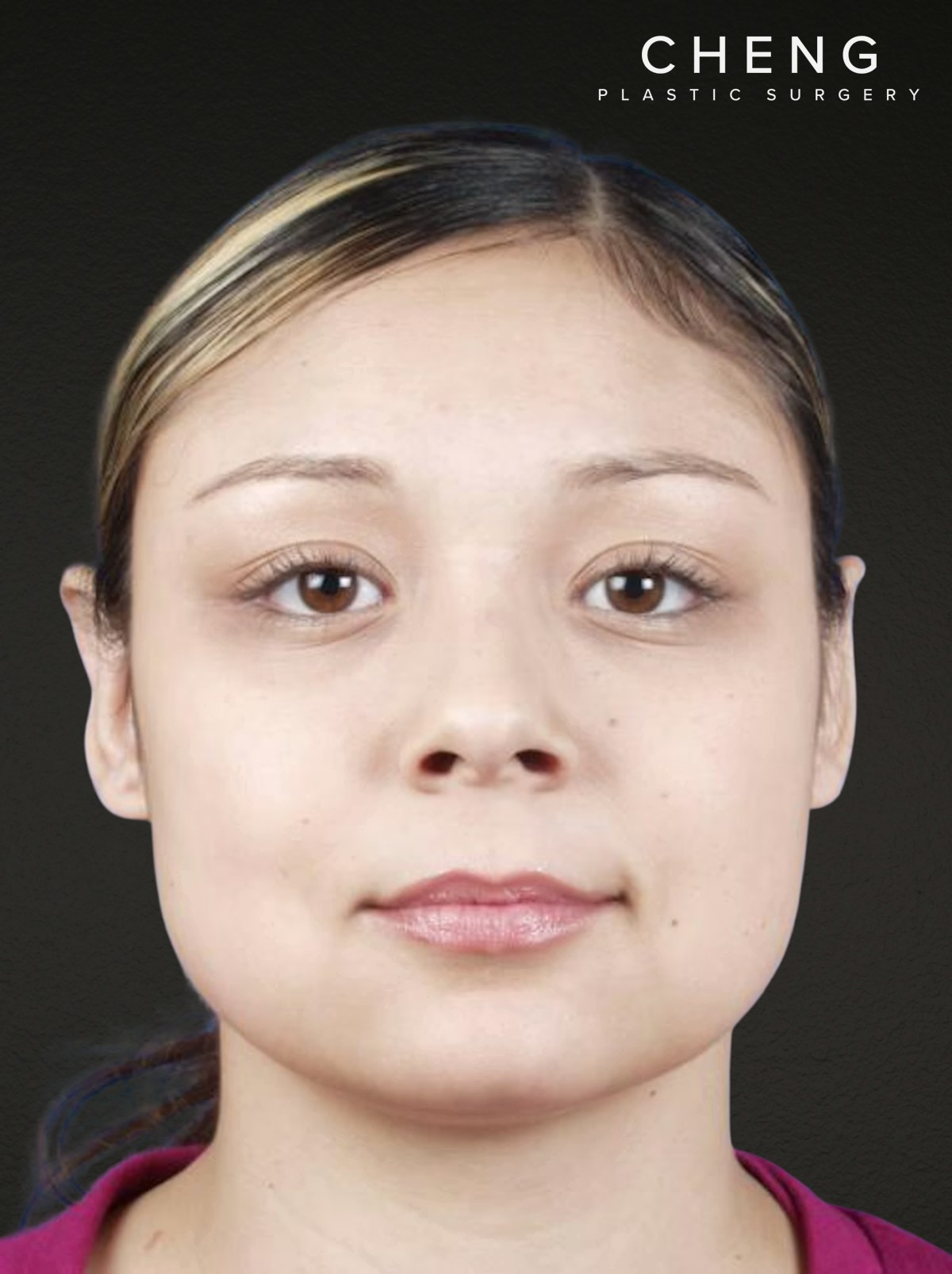 Otoplasty Before & After Gallery - Patient 316708 - Image 2