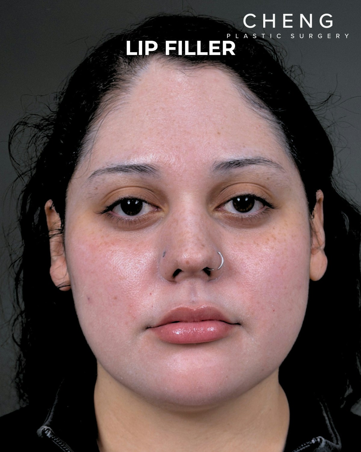 Dermal Fillers Before & After Gallery - Patient 203654 - Image 2