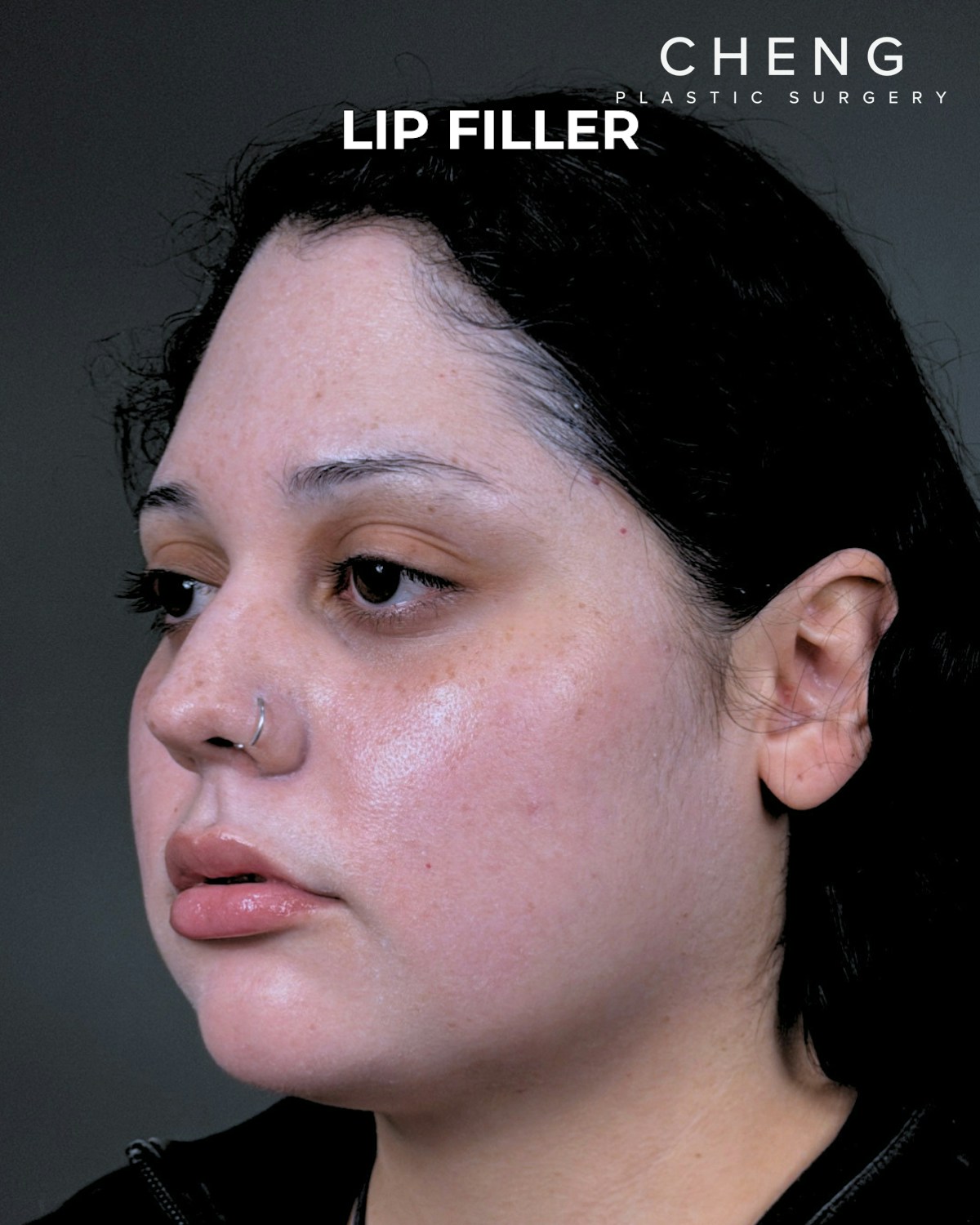 Dermal Fillers Before & After Gallery - Patient 203654 - Image 4