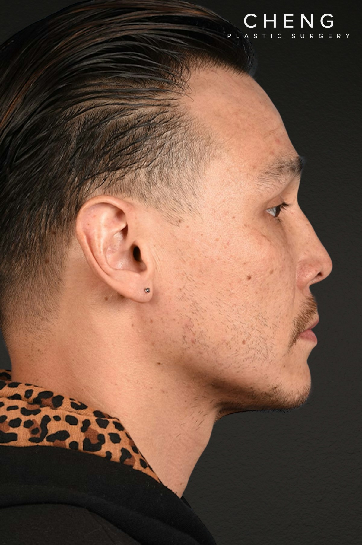 Hair Transplant With NeoGraft Before & After Gallery - Patient 494446 - Image 6