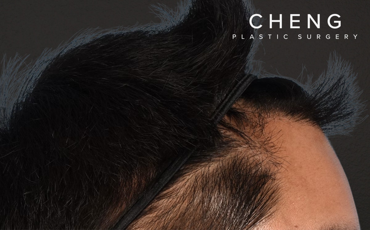 Hair Transplant With NeoGraft Before & After Gallery - Patient 421962 - Image 10