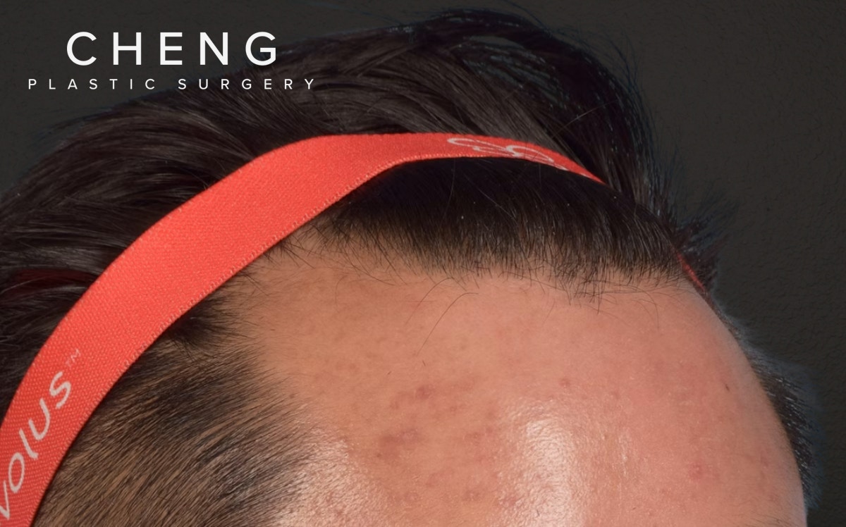 Hair Transplant With NeoGraft Before & After Gallery - Patient 421962 - Image 3