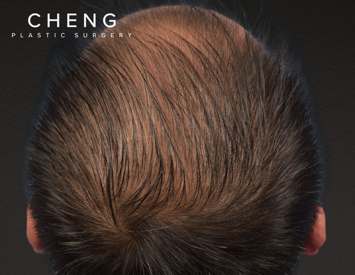Hair Transplant With NeoGraft Before & After Gallery - Patient 242971 - Image 3