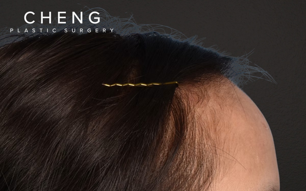 Hair Transplant With NeoGraft Before & After Gallery - Patient 984625 - Image 5